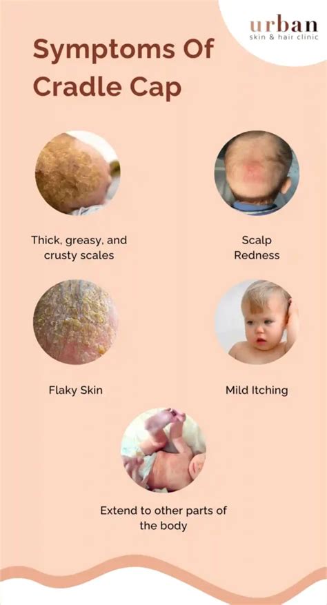 adult cradle cap symptoms.